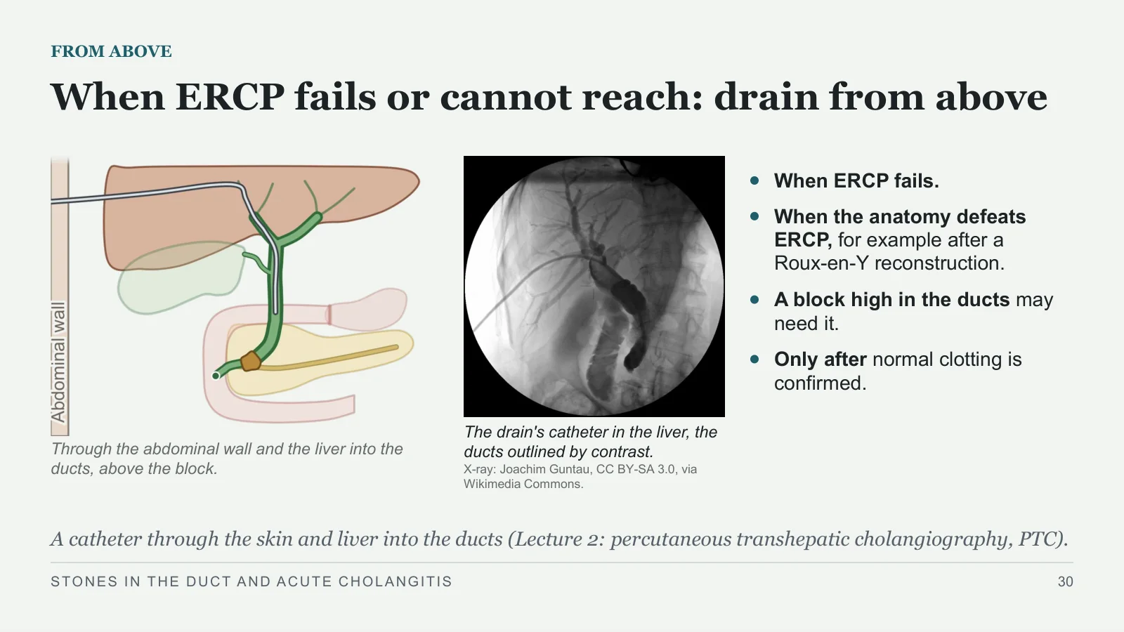 Slide 30: When ERCP fails or cannot reach: drain from above