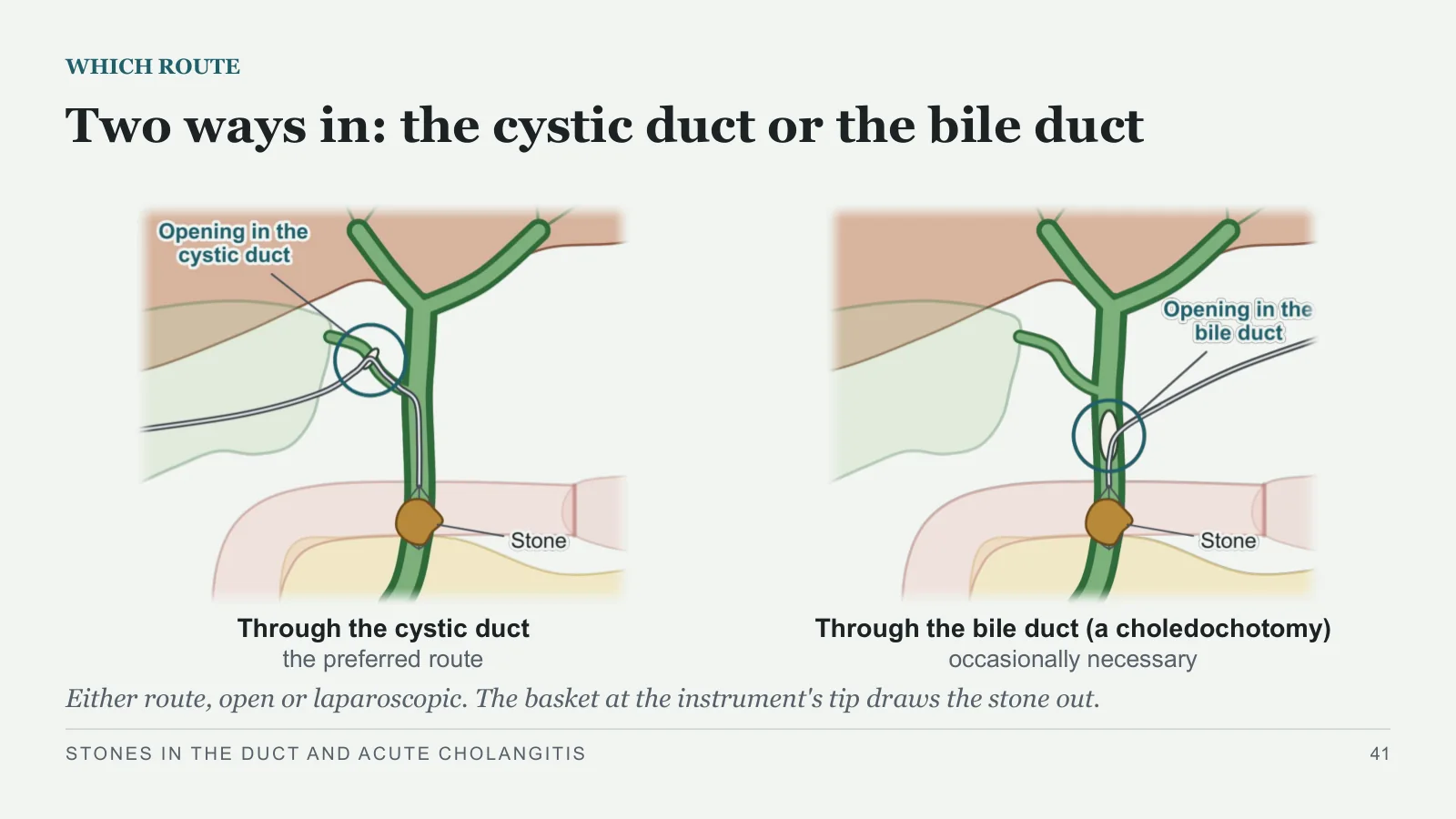 Slide 41: Two ways in: the cystic duct or the bile duct