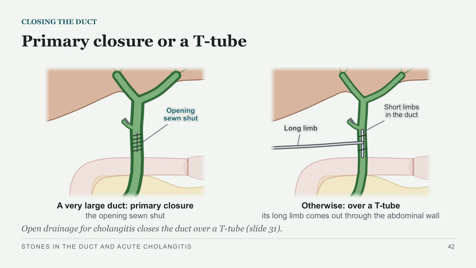 Slide 42: Primary closure or a T-tube