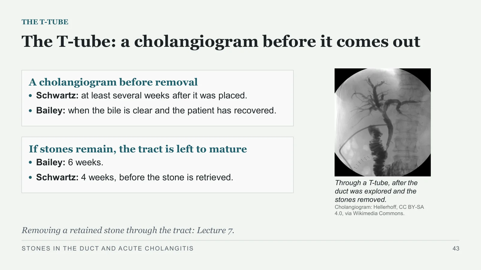 Slide 43: The T-tube: a cholangiogram before it comes out