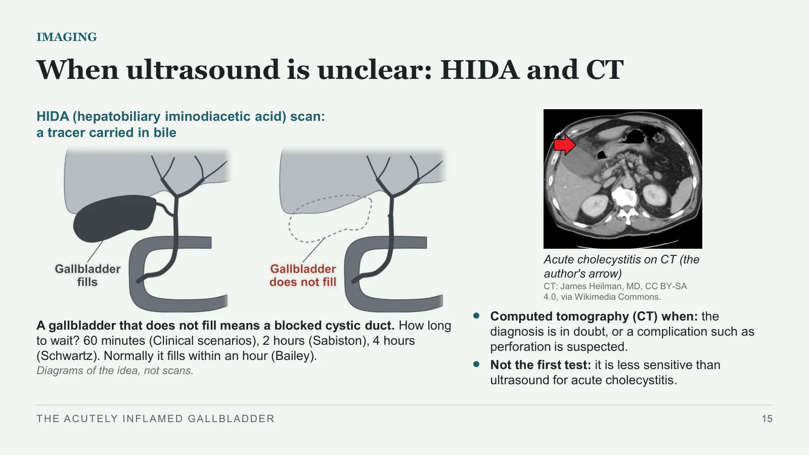 Slide 15: When ultrasound is unclear: HIDA and CT