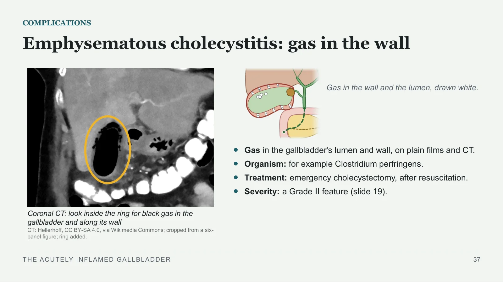 Slide 37: Emphysematous cholecystitis: gas in the wall