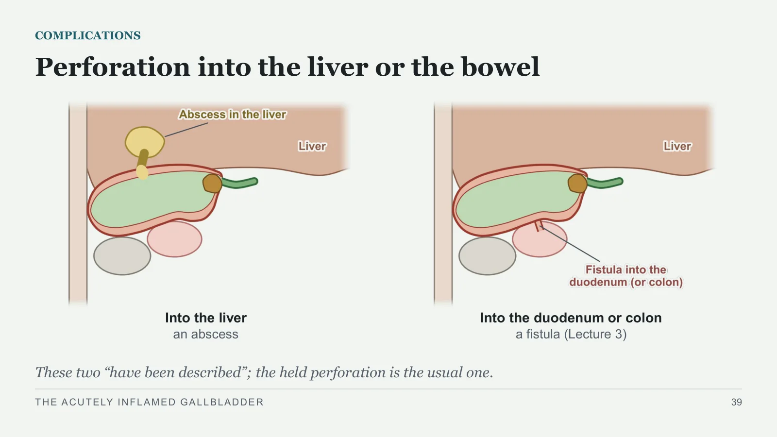 Slide 39: Perforation into the liver or the bowel