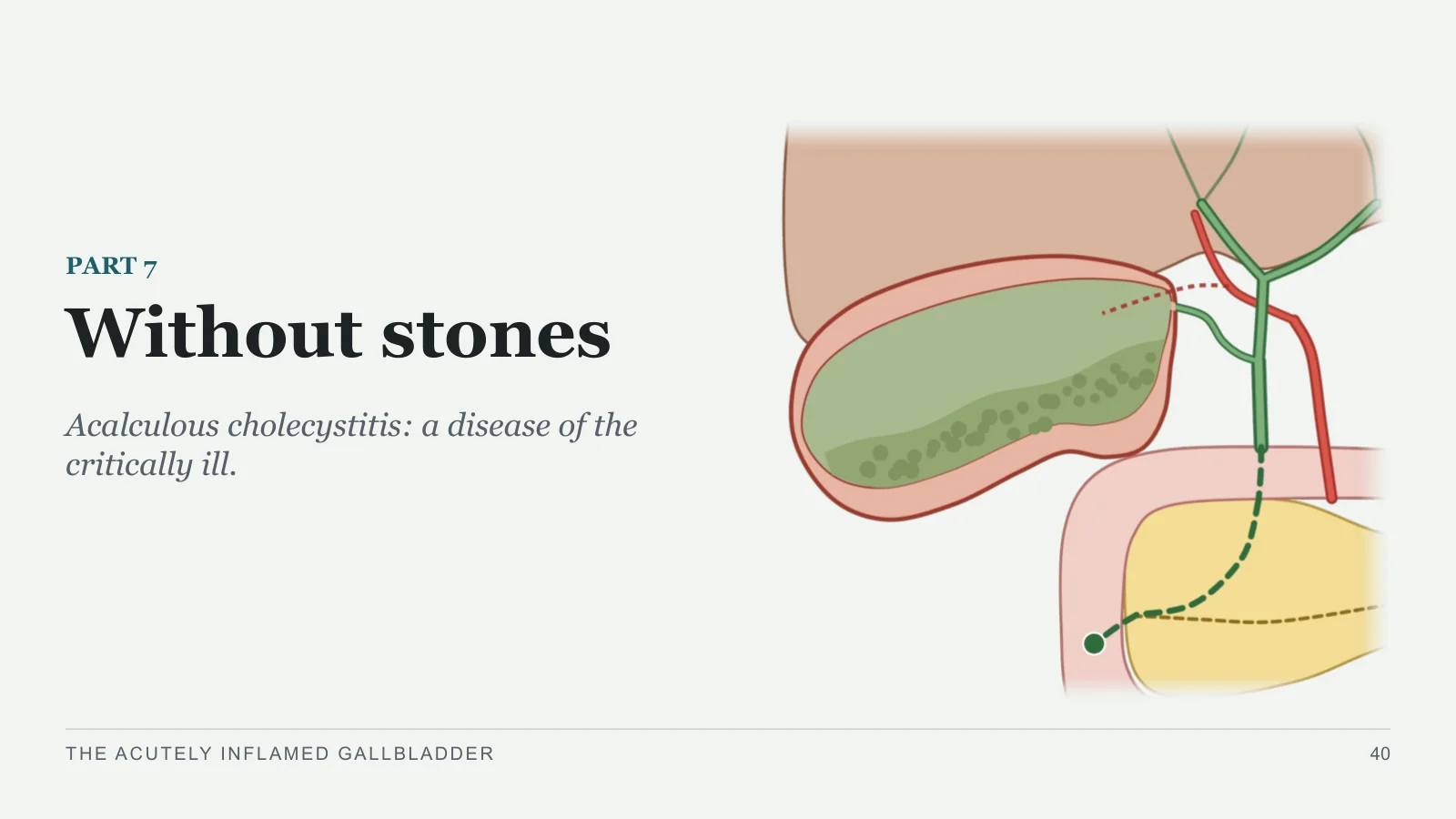 Slide 40: Without stones