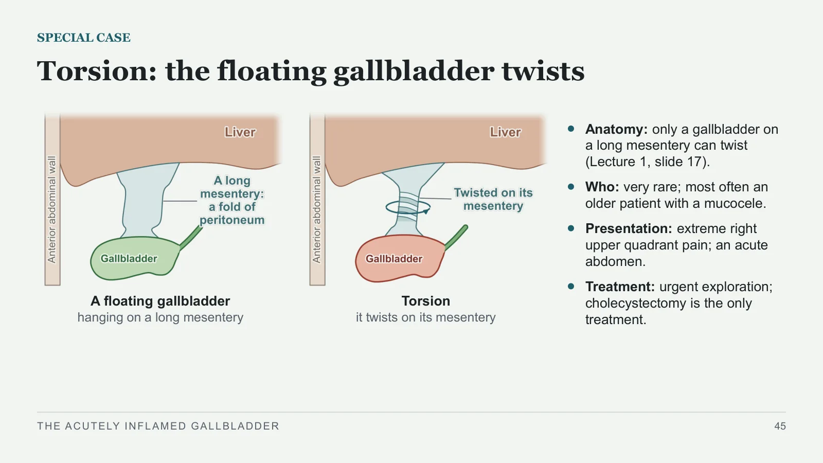 Slide 45: Torsion: the floating gallbladder twists