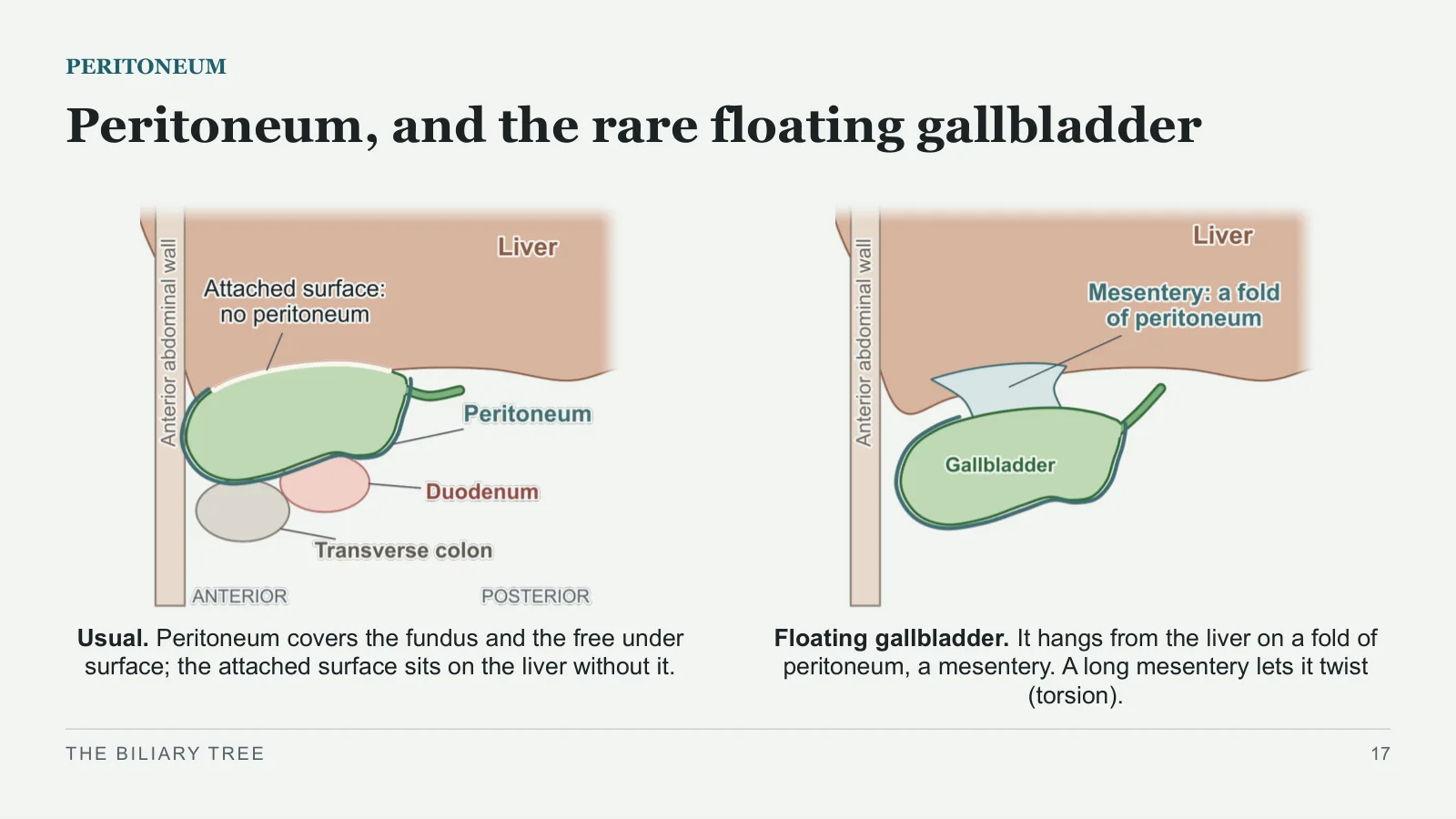 Slide 17: Peritoneum, and the rare floating gallbladder