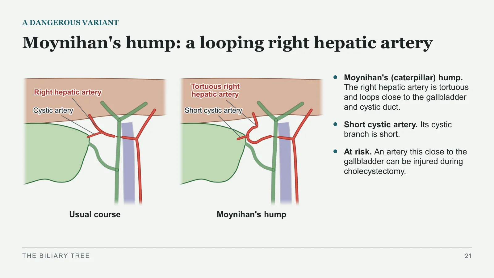 Slide 21: Moynihan's hump: a looping right hepatic artery