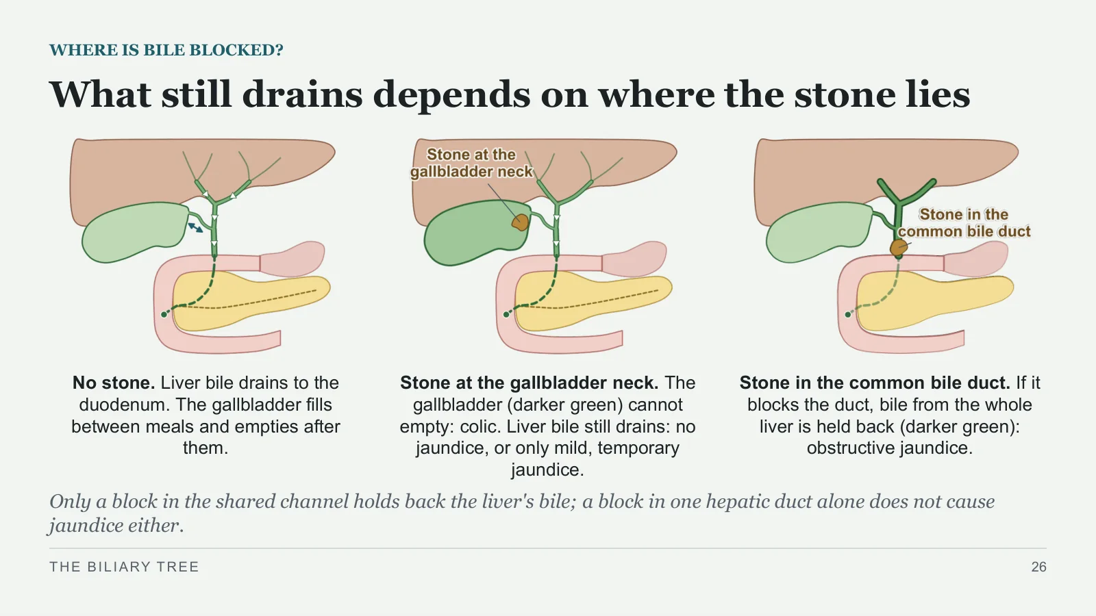 Slide 26: What still drains depends on where the stone lies
