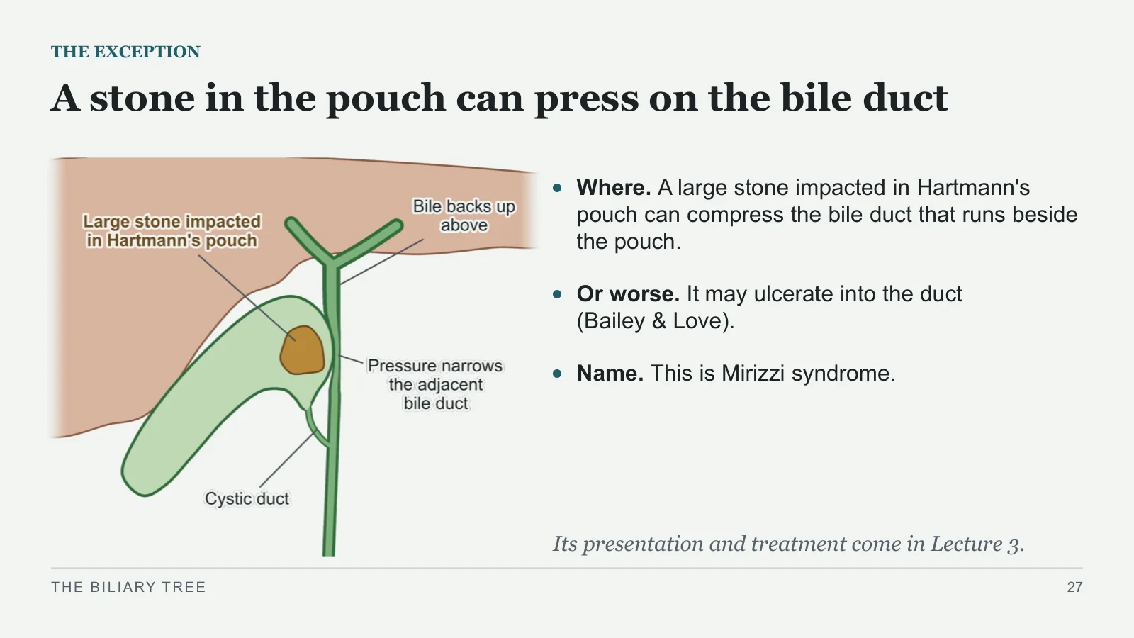 Slide 27: A stone in the pouch can press on the bile duct