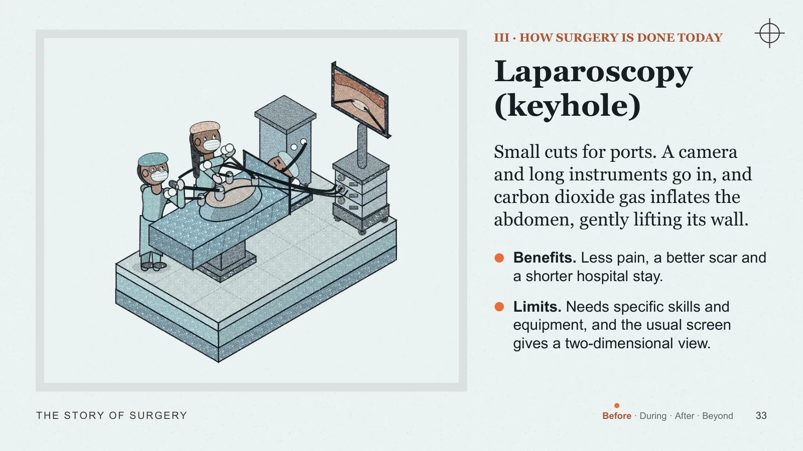 Slide 33: Laparoscopy (keyhole)